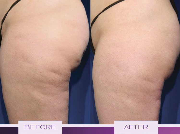 Cellulite Treatment in NYC  The Dermatology and Laser Group