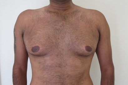 Psychological outcomes following ultrasound-assisted gynaecomastia