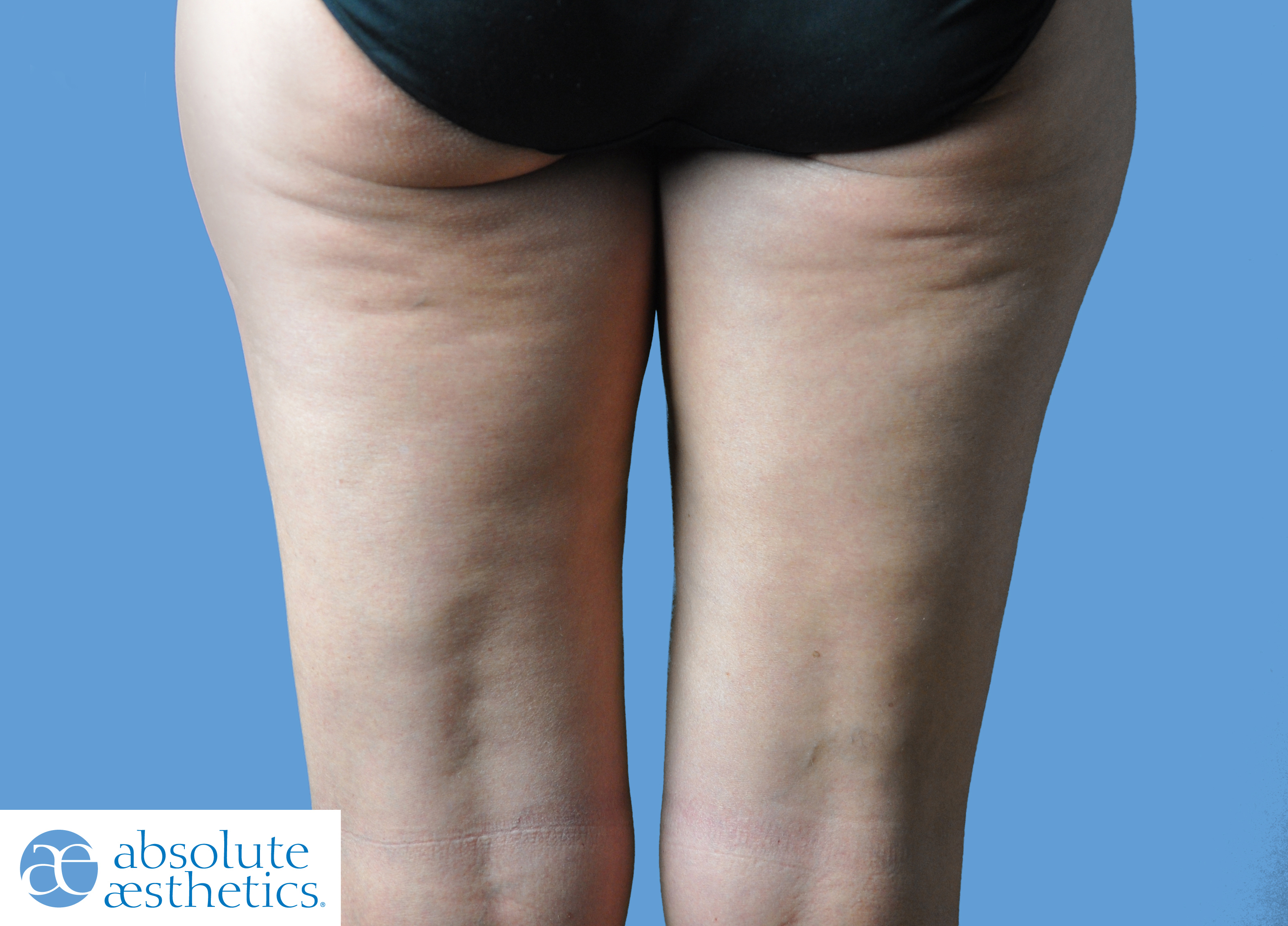 Cellulite does wearing compression hosiery work The PMFA Journal