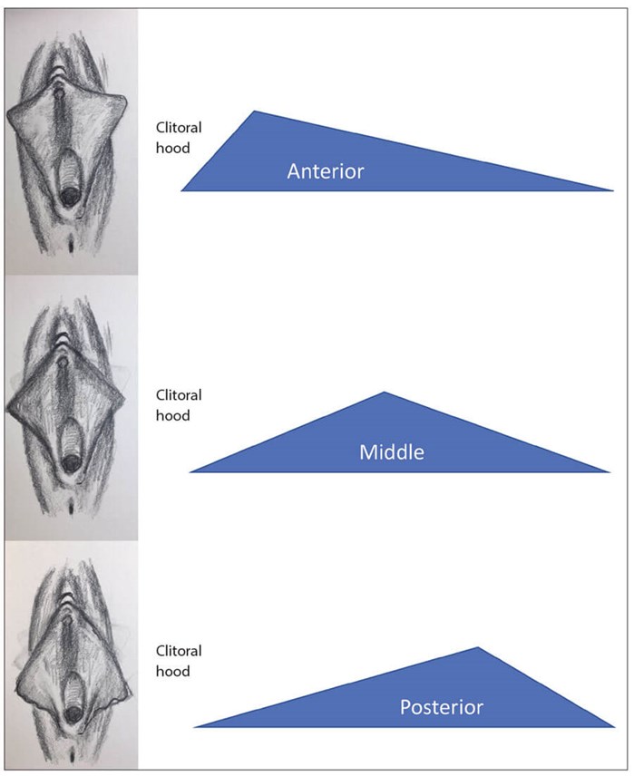 Cosmetic Labiaplasty – Basic Relevant Anatomy And Surgical