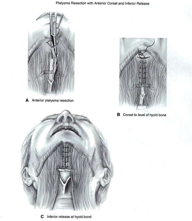 HOW I DO IT A guide to anterior neck lift aesthetic surgery | The PMFA ...