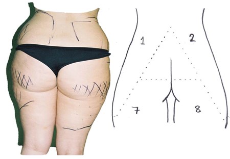 Gluteal Aesthetic Unit Classification