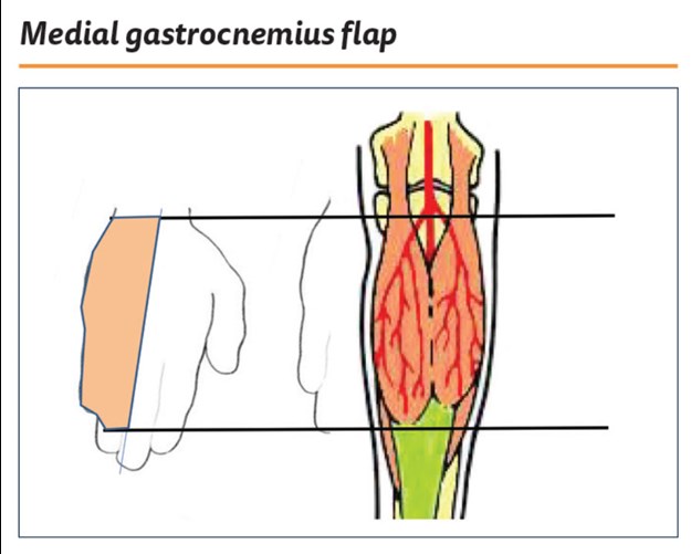 Medial Gastrocnemius Muscle