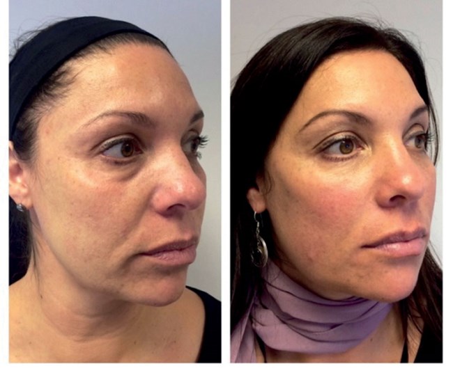 HOW I DO IT Peri-orbital rejuvenation using HA fillers | The PMFA Journal