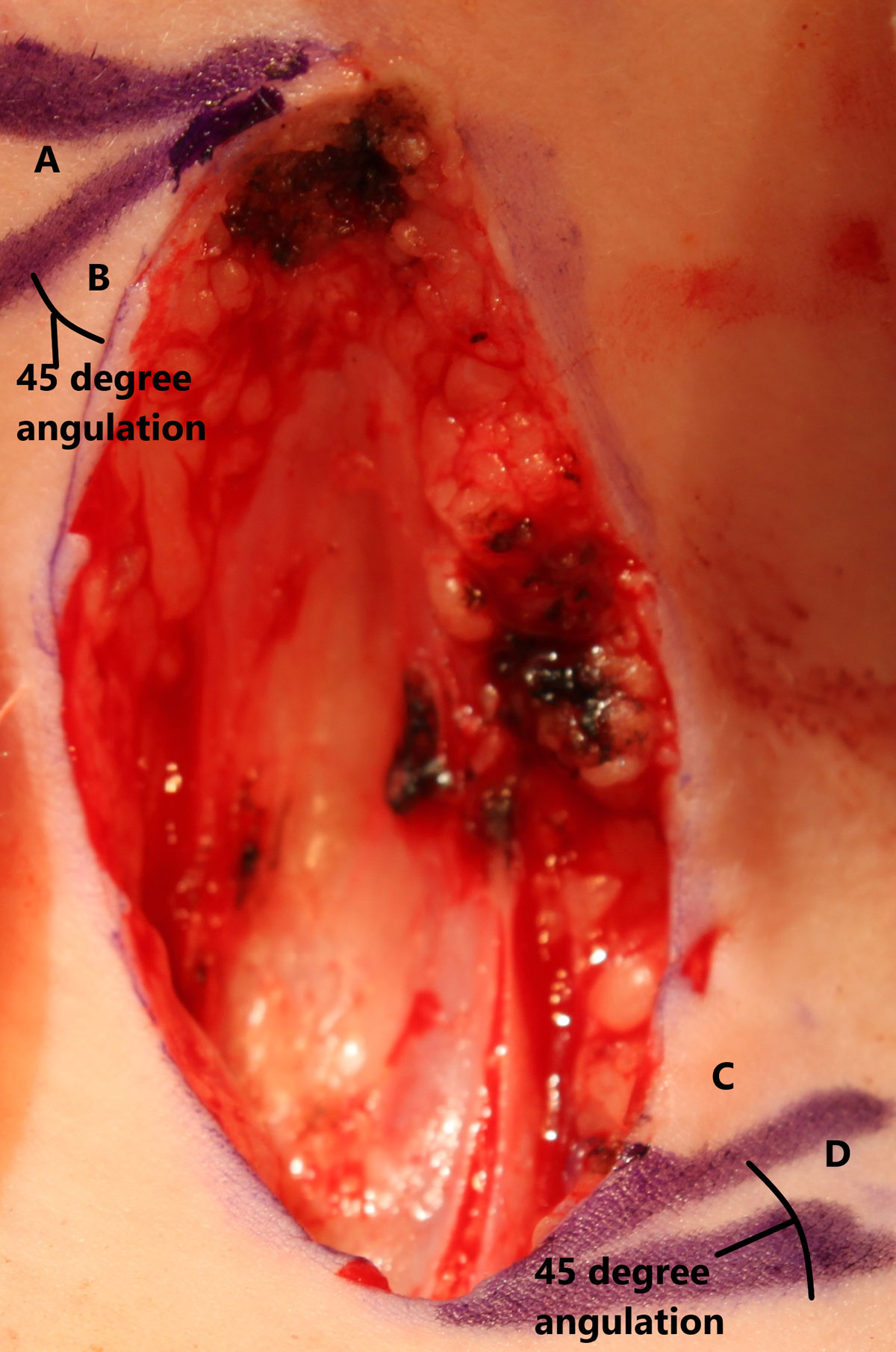 HOW I DO IT - Congenital midline cervical cleft excision and