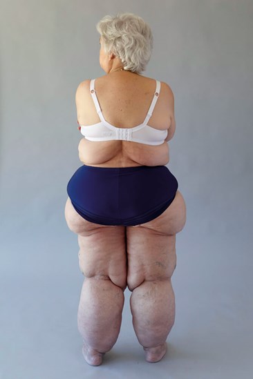 Life with Lipedema - Lipedema occurs in stages with worsening