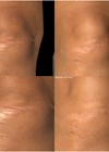 Photos showing HB 3D baseline pre & post comparison knee scar. 