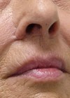 Photo showing completed lip lift with bull-horn flap inset.