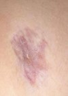 Photo of Chloé's keloid scarring following surgery.