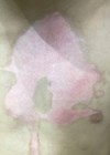 Photo showing ten days after a scald burn to the chest.