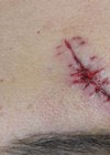 Image of wound before stromal vascular fraction and PICO laser treatment.