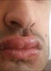 Photo showing patient presented several months later with upper and lower lip painless oedema.