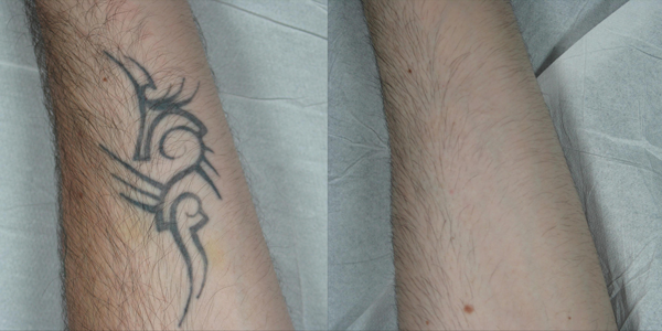 Results immediately after first session with picosure laser tattoo removal   rTattooRemoval